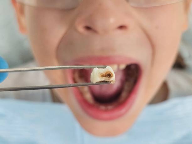 Best Emergency Treatment for Oral Infections in Russellville, AR